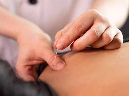 Dry needling physiotherapy clinic Dublin